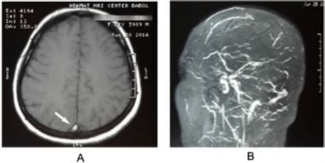 Cerebral Venous Thrombosis Concise Medical Knowledge