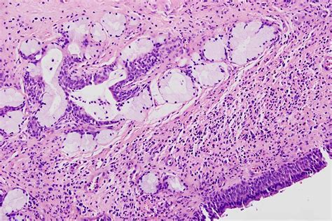 50 Facts About Bartholins Cyst
