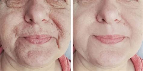 Wrinkles before after Stock Photos, Royalty Free Wrinkles before after ...