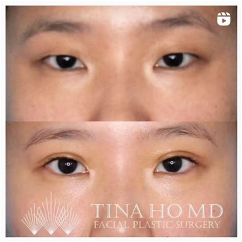 Blepharoplasty Philadelphia Eyelid Surgery Wayne