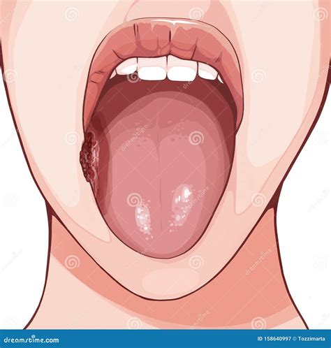 Squamous Cell Carcinoma is the Most Common Type of Tongue Cancer. Stock
