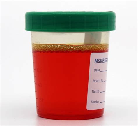 Red Urine