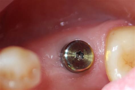 Формувач ясен при імплантації: що це таке, фото, опис | Dental Art