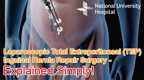 Inguinal Hernia Repair Anatomy
