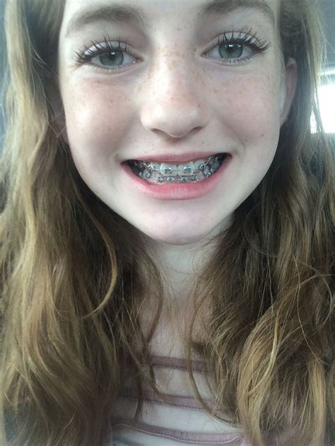 Pin By Strawberiey On Friends Braces Girls Cute Braces Blonde Hair Girl