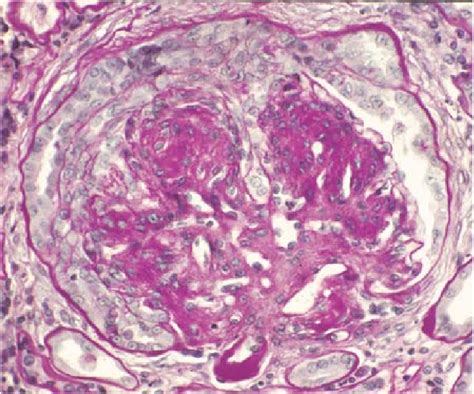 6 Glomerulus From Patient With Diabetic Glomerulosclerosis Showing