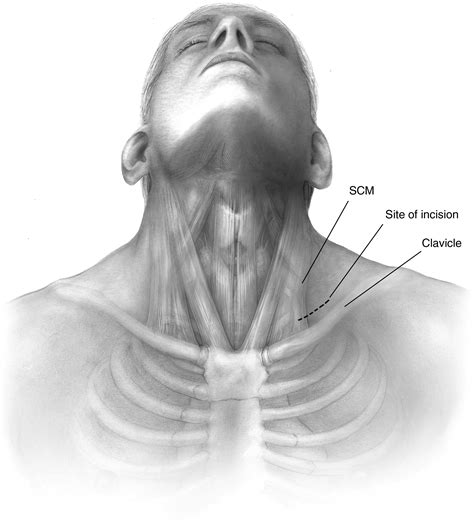 Supraclavicular First Rib Resection Operative Techniques In Thoracic And Cardiovascular Surgery