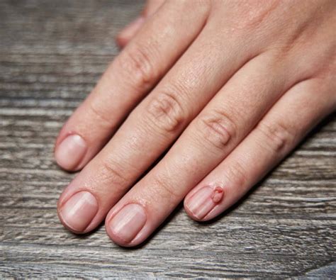 Periungual Warts Recognition Treatment And More
