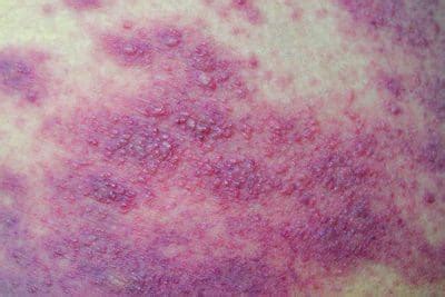 Moisture-associated skin damage: The basics