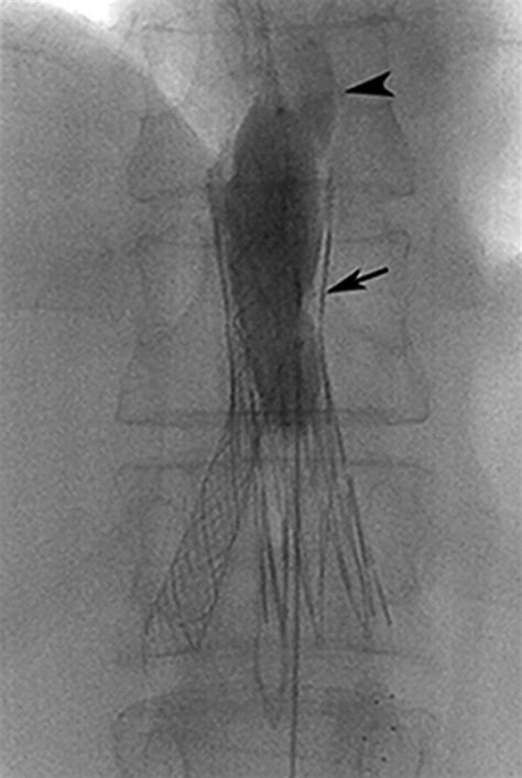 Direct Intrahepatic Portocaval Shunt Creation Via The Inter Strut Space