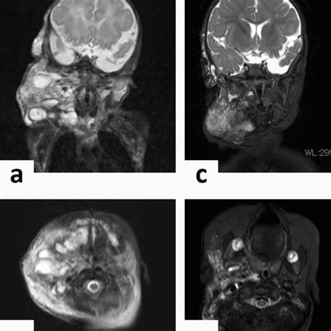 Case 3. a Large lymphatic malformations (LMs) occupied the mandible and ...