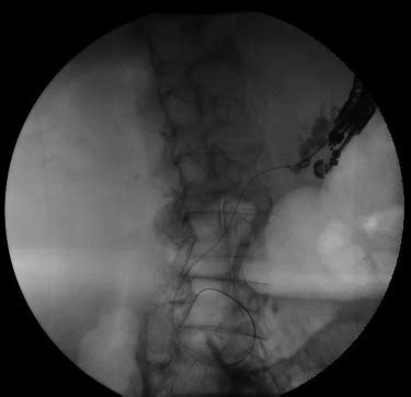 Eus Guided Rendezvous Technique For Pancreas Divisum Videogie