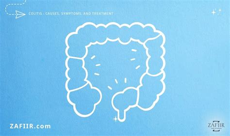 colitis  symptoms  treatment