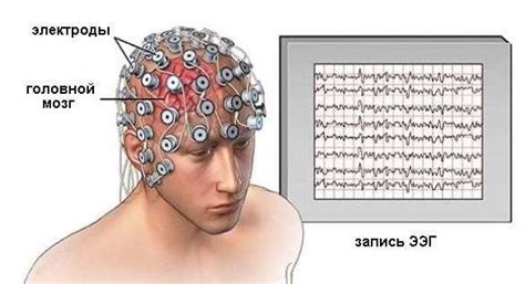 Электроэнцефалография (ЭЭГ) | Клинический госпиталь КОМИР