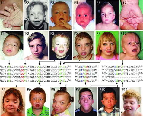 Novel Mutations Of Kras In Patients With Noonan Syndrome Spectrum