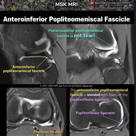 Popliteofibular Ligament Mri