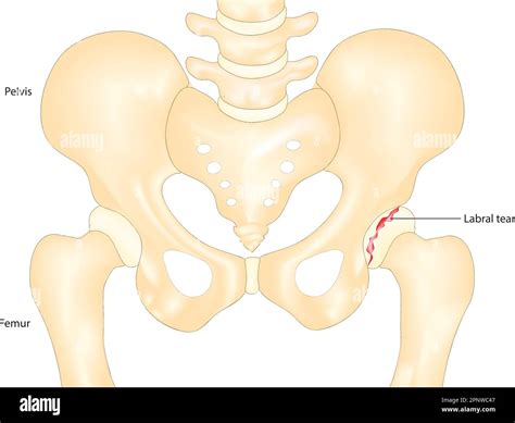 Syndrome De Hanche Claquant Banque D Images Vectorielles Alamy