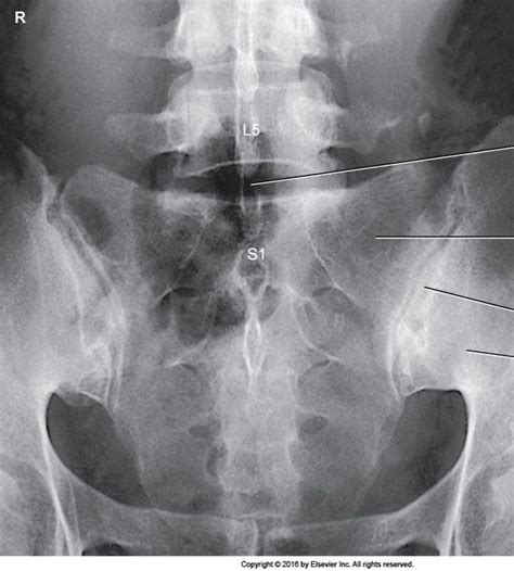 AP Axial Lumbosacral Junction And Sacroiliac Joints Ferguson Method