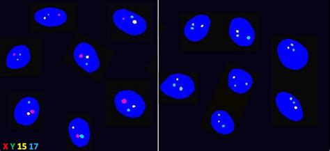 In The Controversial Field Of Sex Selection D Eurekalert