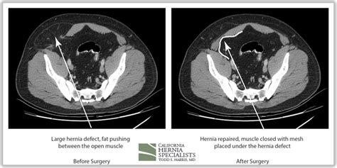 Recent Case Highlights - California Hernia Specialists