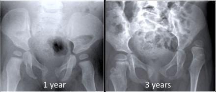 The Radiology Assistant Developmental Dysplasia Of The Hip