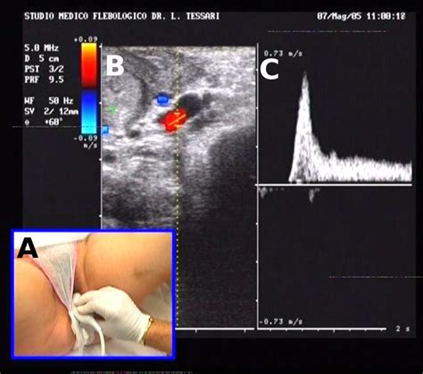 Perineal Foam Sclerotherapy Josef Pflug Vascular Laboratory