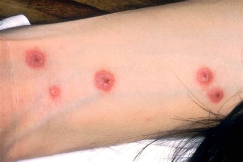 Hiv Blisters Arms