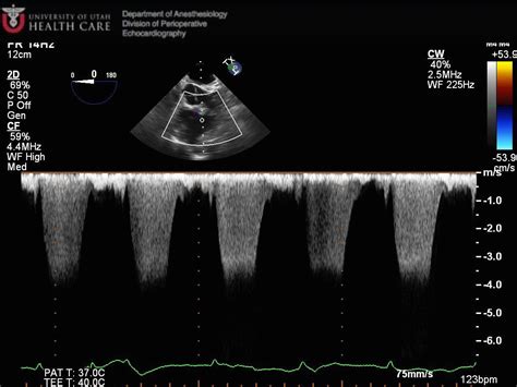 Interesting Cases Echocardiography And Perioperative Ultrasound