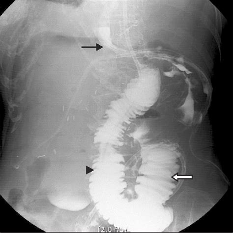 Figure 1 From Early Postoperative Retrograde Jejunojejunal Intussusception After Total