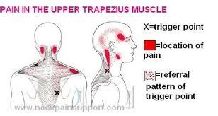 Upper Trapezius Archives - Myofascial Pain Solutions