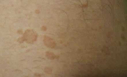Коричневые пятна на коже появились: причины, симптомы и лечение