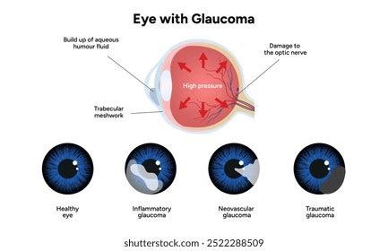 healthy eye eye glaucoma ophthalmology anatomy stock vector royalty