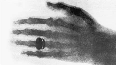 Primeira Radiografia Da História - Radiografia vintage? Saiba como eram os exames de raio X no século ...