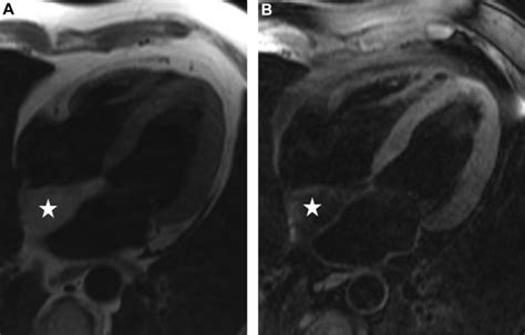 Lipomatous Hypertrophy Of The Interatrial Septum A Case Report And Review Of The Literature Pmc