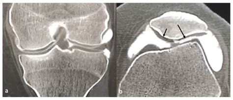 Life Free Full Text Imaging Of Cartilage And Chondral Defects An