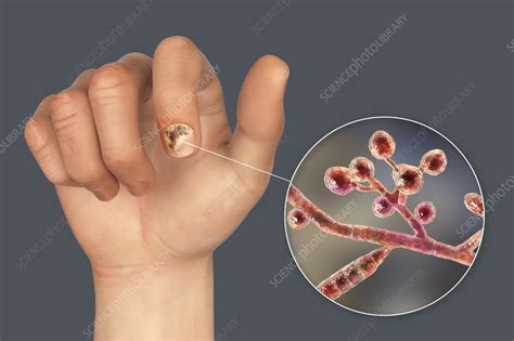 Fungal Nail Infection Illustration Stock Image F0364056 Science