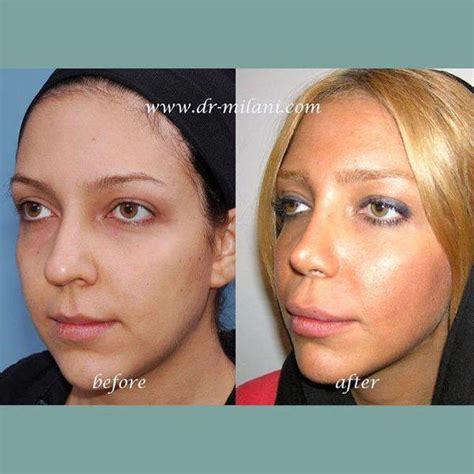 Iranian Nose Plastic Surgery Before And After 4 Rhinoplasty Cost