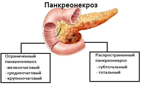 Панкреонекроз – симптоми, причини, діагностика та лікування | Як лікувати
