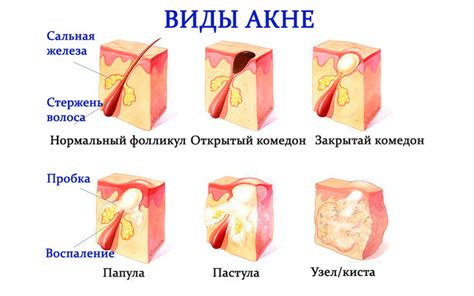 Комедоны на лице (закрытые, открытые): причины возникновения, лечение ...
