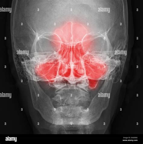 ray image  paranasal sinuses  diagnosis sinusitis stock photo