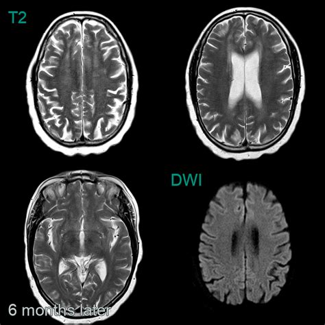 Hiv Encephalopathy Neuroradiology