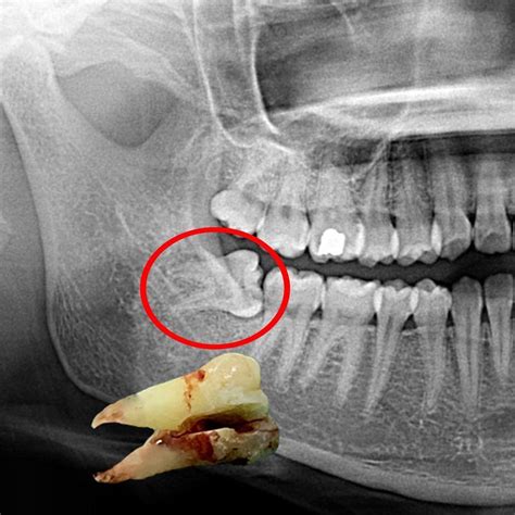 Wisdom Teeth Removal in Davie | Plantation, FL