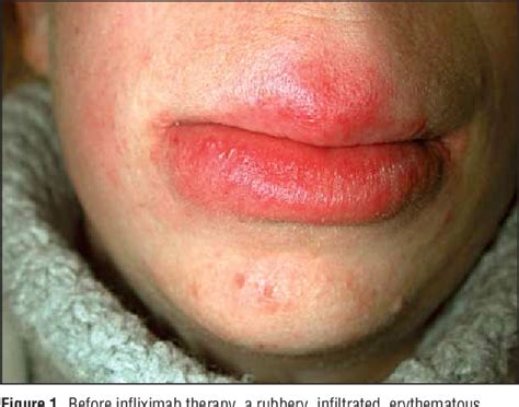 Figure 3 From Treatment Of Granulomatous Cheilitis With Infliximab