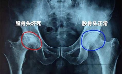 257粗隆间骨折之手术方式篇 - 知乎