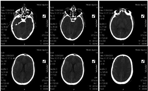 Ct Scan Of The Brain Of Patient 5 Showing Cerebral Edema On Illness Day Download Scientific