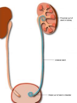 How is a ureteral stent placed?