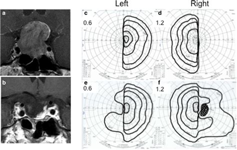 Representative Case 1 A Non Functioning Pituitary Adenoma In A