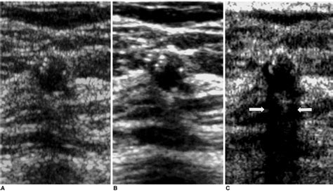 Sonograms Of A 52 Year Old Woman Show A Well Defined Hypoechoic Round