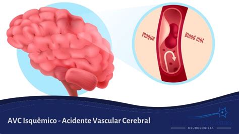 Avc Isquêmico O Que é O Acidente Vascular Cerebral Isquêmico