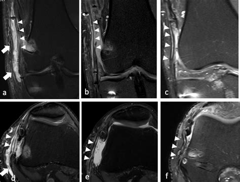 Figure 4 From Iliotibial Band Reconstruction With Allograft Fasciae